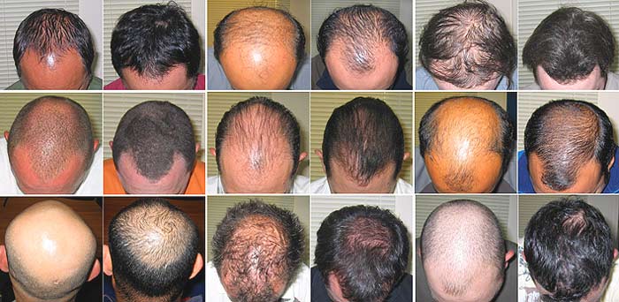 can you regrow hair in a bald spot